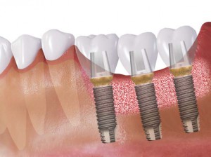 Osstem csontpótlás, implantálás